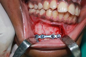 Facial Trauma Care 2 Fractured Bone Stabilized Using Bone Plate