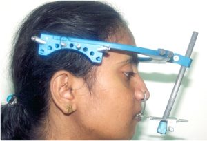 Distraction Osteogenesis 3 Distraction With Rigid External Distractor (Red)